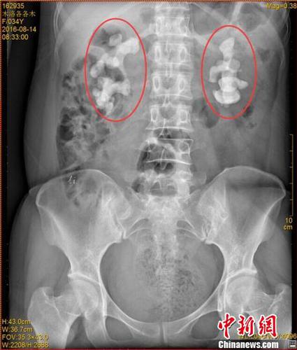四川一女子喝生水30余年雙腎長(zhǎng)10厘米巨型結(jié)石