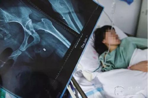 女子陽臺遭槍擊-臀部中彈深達20厘米2