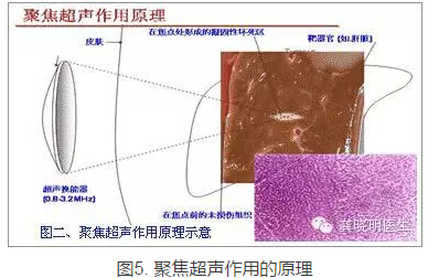 龔曉明：1/3女性都有的子宮肌瘤到底是啥