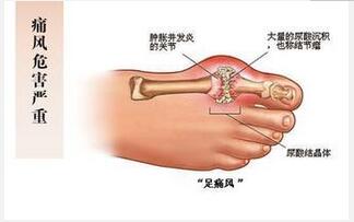 痛風病人吃什么好？ 飲食需合理搭配