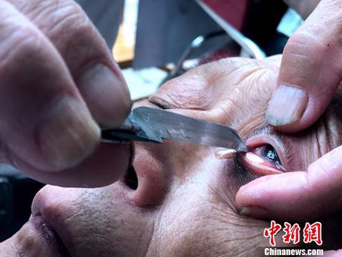 驚險又刺激的“刀鋒洗眼”?！螚?攝