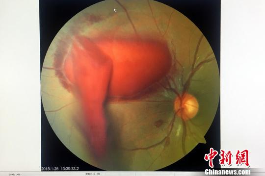 小潘的眼底照相檢查圖，紅色塊為眼底出血血塊?！＄娦?攝