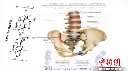 中國科學(xué)家等揭示漢族人群強直性脊柱炎關(guān)聯(lián)基因